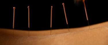 Chiropractic Alexandria VA Dry Needling